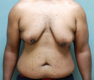 manhattan gynecomastia surgery before 1